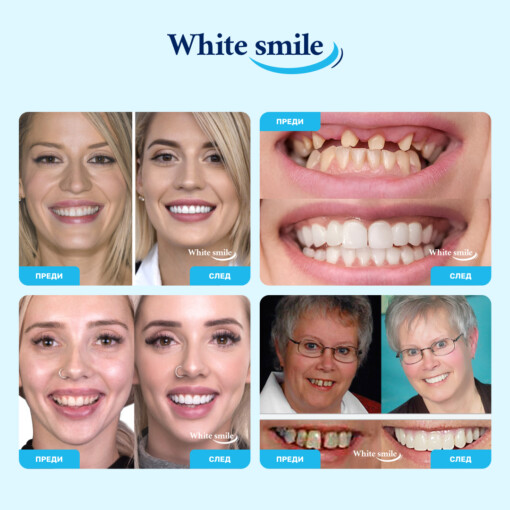 Изкуствени зъби WhiteSmile - Image 2