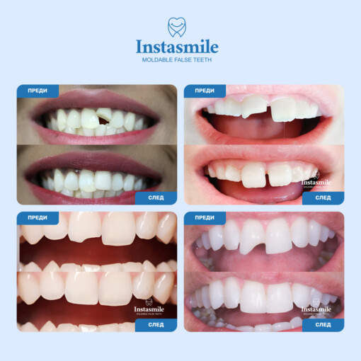 INSTASMILE КОМПЛЕКТ ЗА ПОПРАВКА НА ЗЪБИ - Image 2
